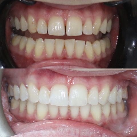 Dental Implants Southport