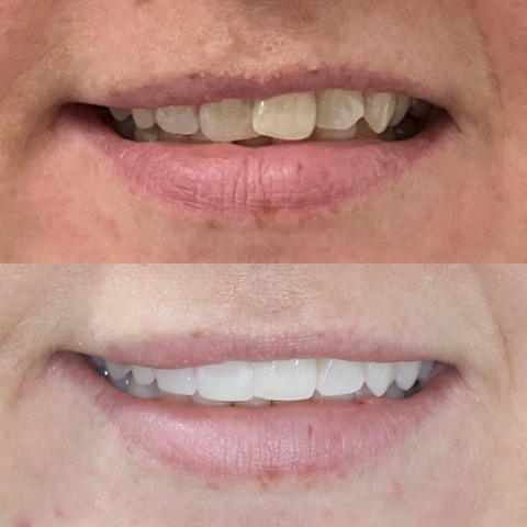 Dental Implants Southport