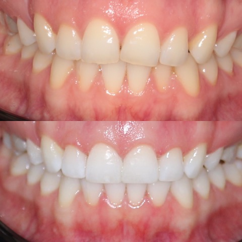 Dental Implants Southport