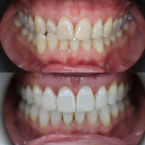 Dental Implants Southport