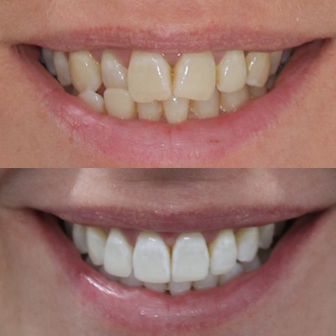 Dental Implants Southport